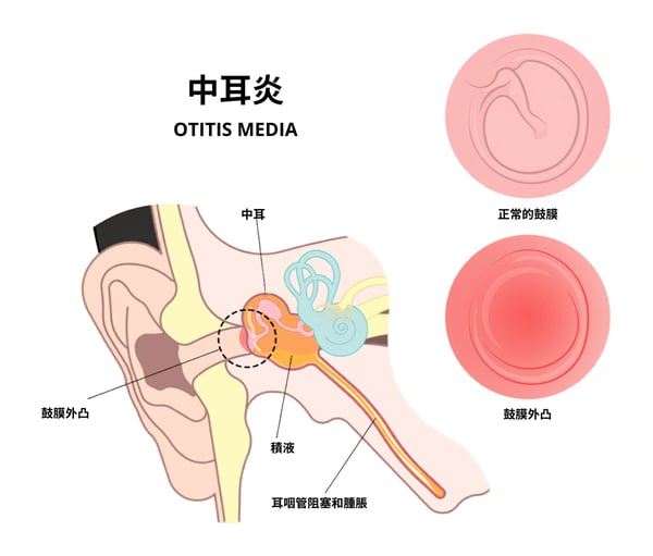 中耳炎