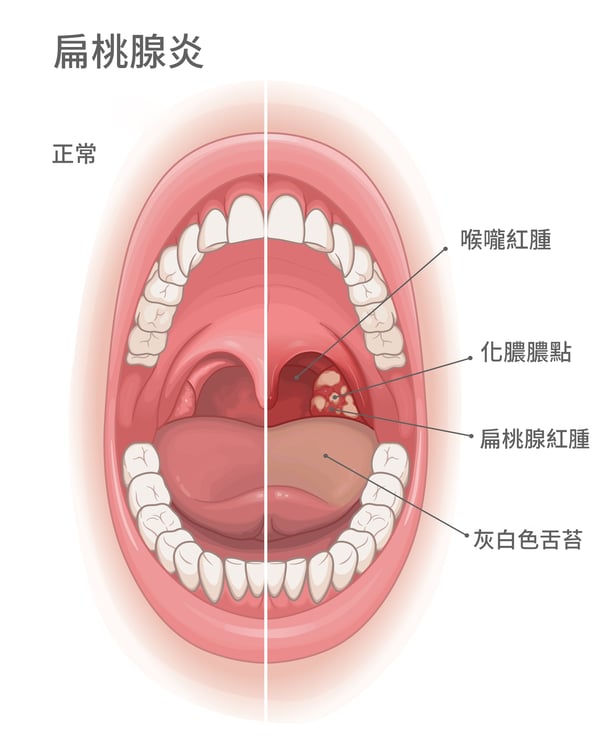 扁桃腺發炎_2