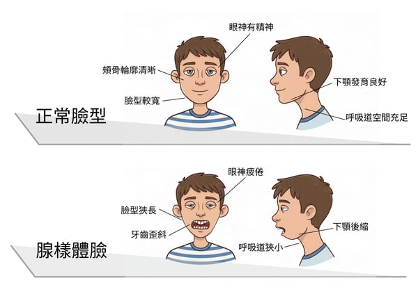 腺樣體臉_1