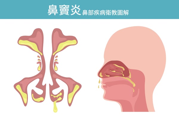 鼻竇炎_2