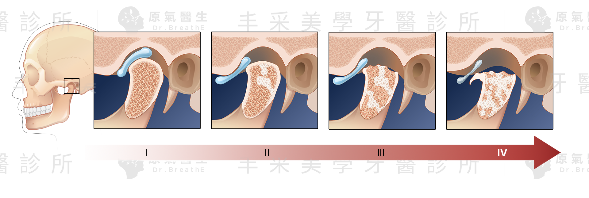 顳顎關節症候群疾病進程