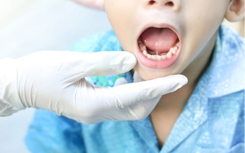 解開舌繫帶-cover