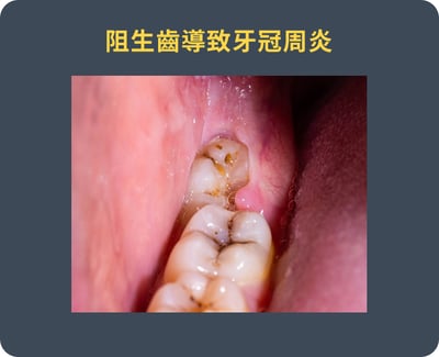 阻生齒牙冠周炎