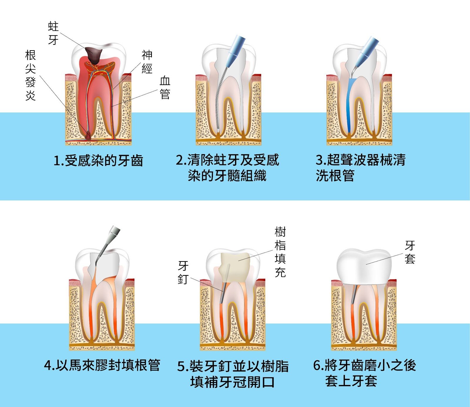 顯微根管治療流程