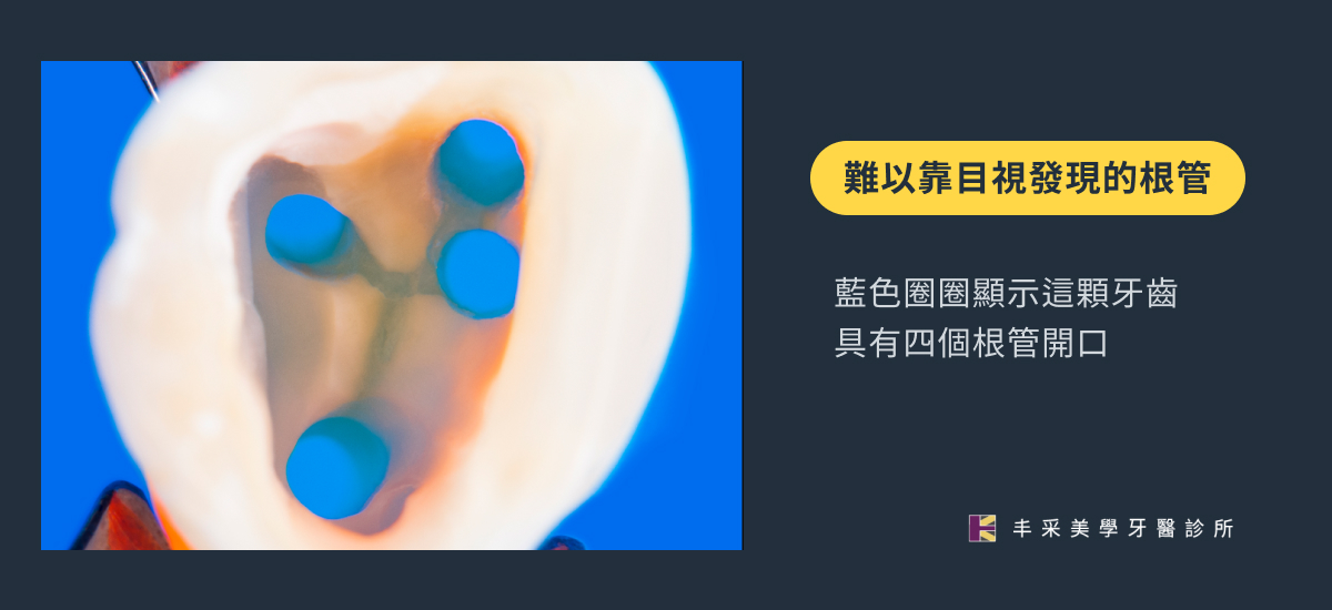 顯微根管結合超音波-1