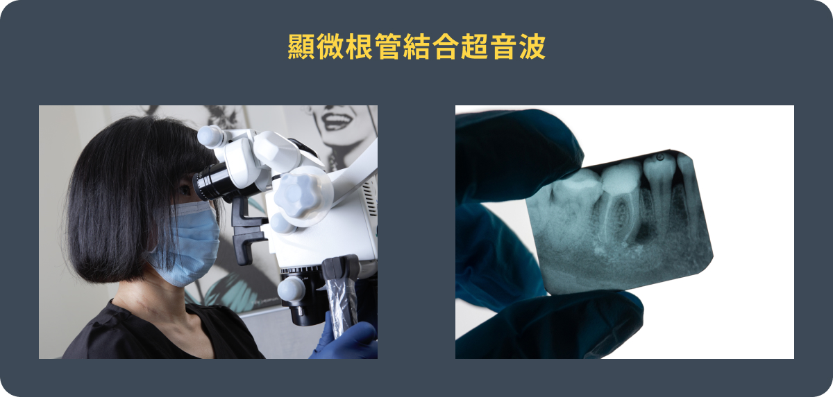 顯微根管結合超音波