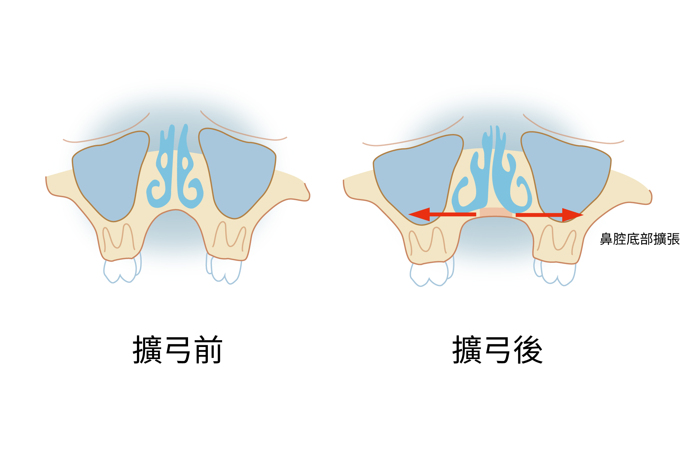 牙弓擴張-插圖_1