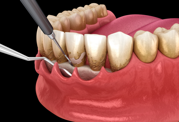 牙周手術｜牙周治療