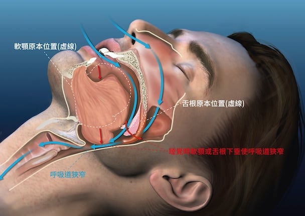 成人睡眠呼吸中止症
