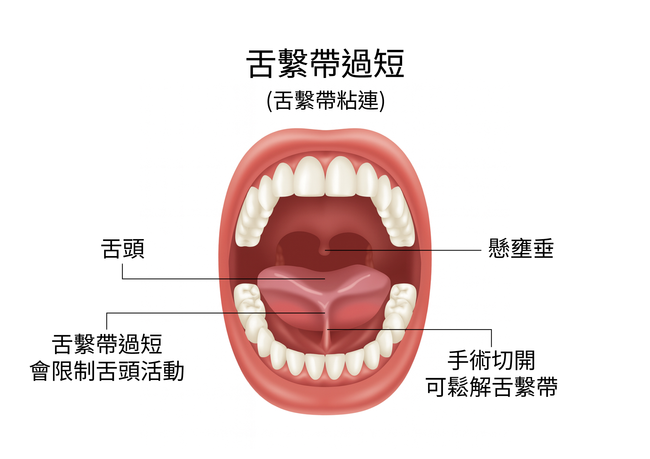 舌繫帶過短_成人