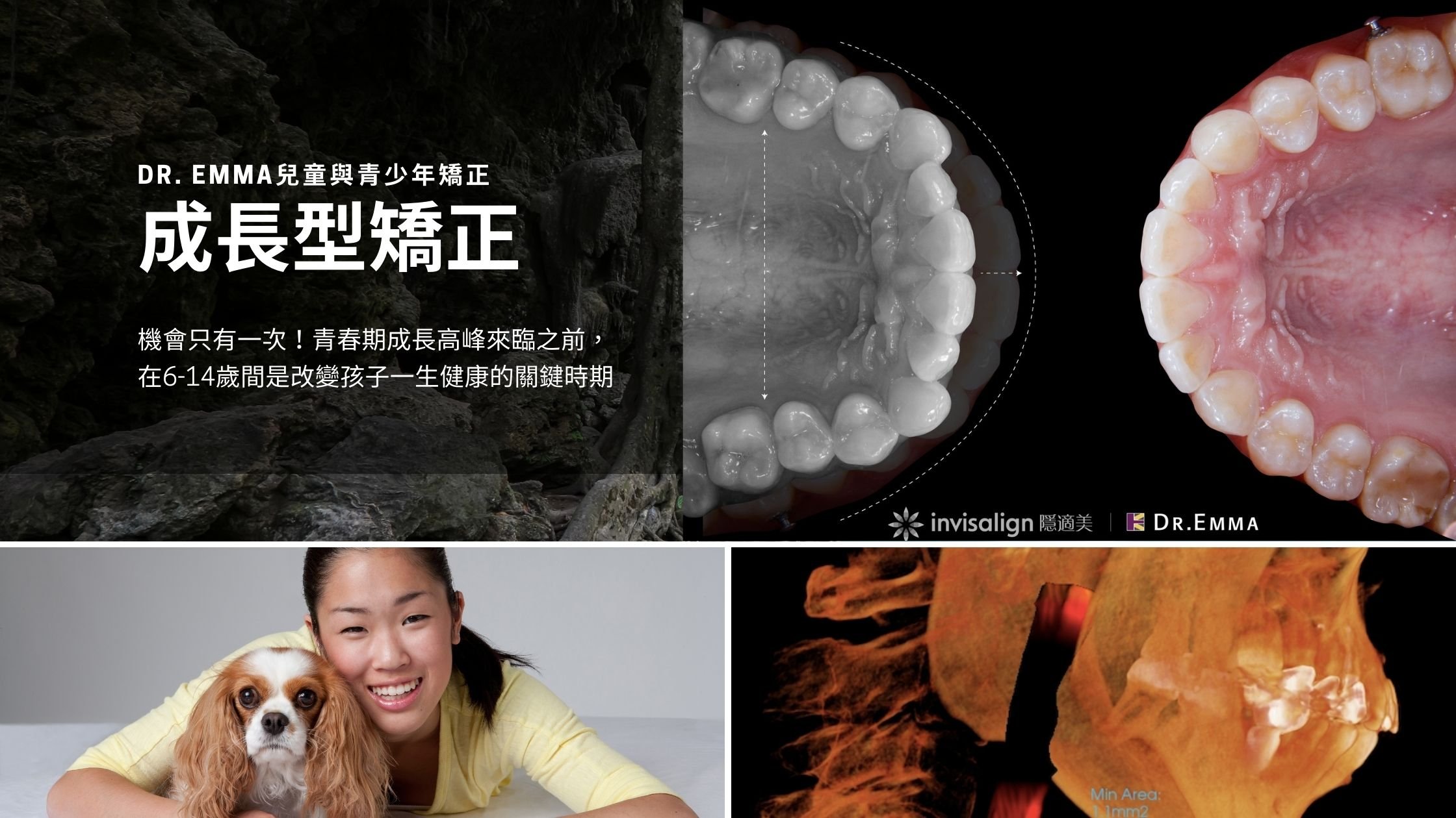 成長型矯正是什麼？Dr. Emma兒童與青少年齒顎矯正