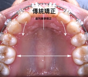 傳統矯正X齒列美學矯正 | Dr.EMMA蔡宜均醫師