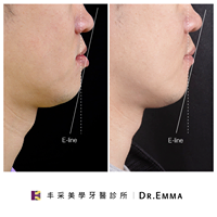 戴牙套前後戽斗臉型變化