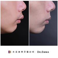 矯正暴牙臉型