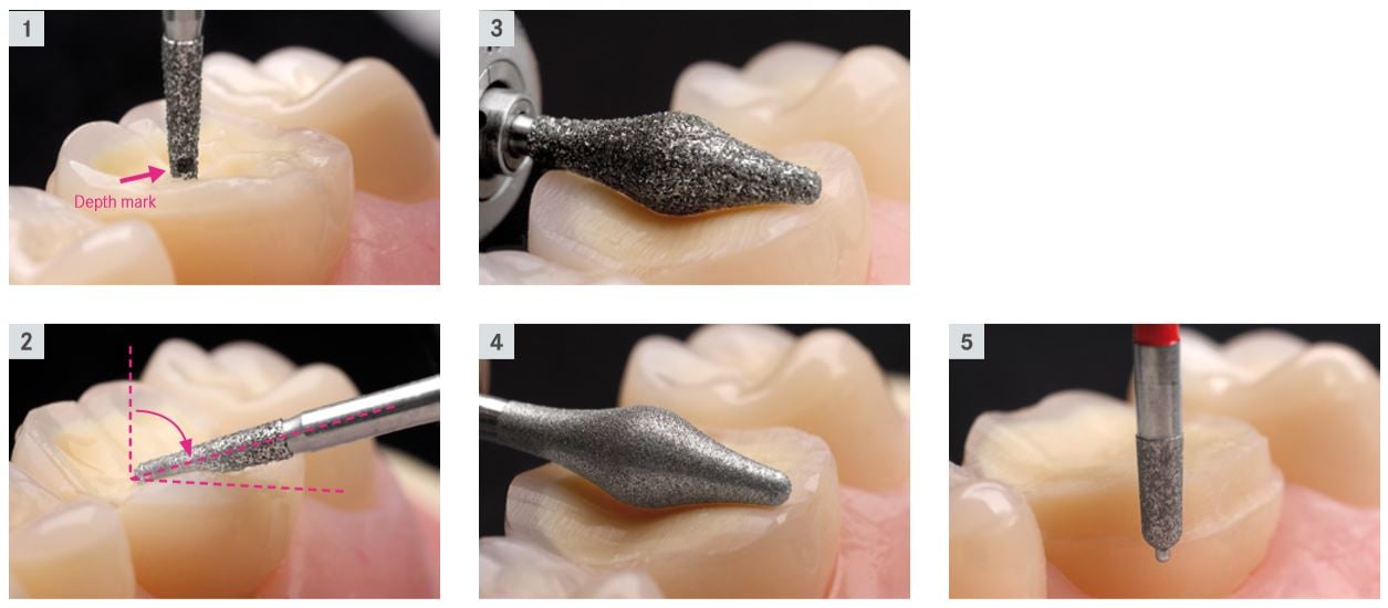 丰采美學牙醫-牙科磨牙使用特殊設計的鑽針器械