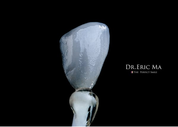 超薄高仿真瓷牙貼片｜Dr.Eric Ma馬永昌醫師