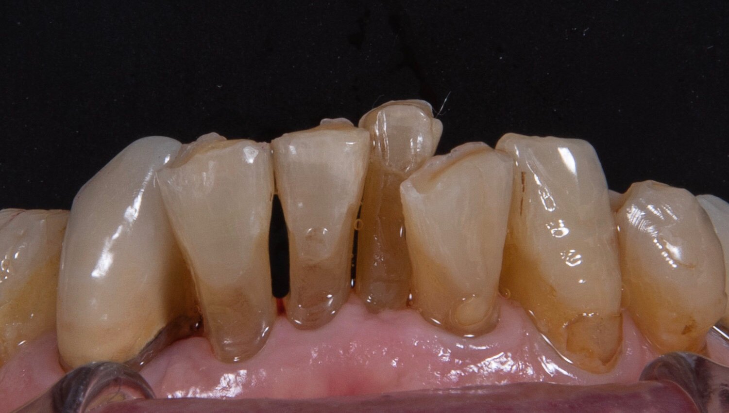 丰采美學牙醫-因長期咬牙(clenching)合併深咬(deep bite)與齒列不整所導致的嚴重齒列磨耗