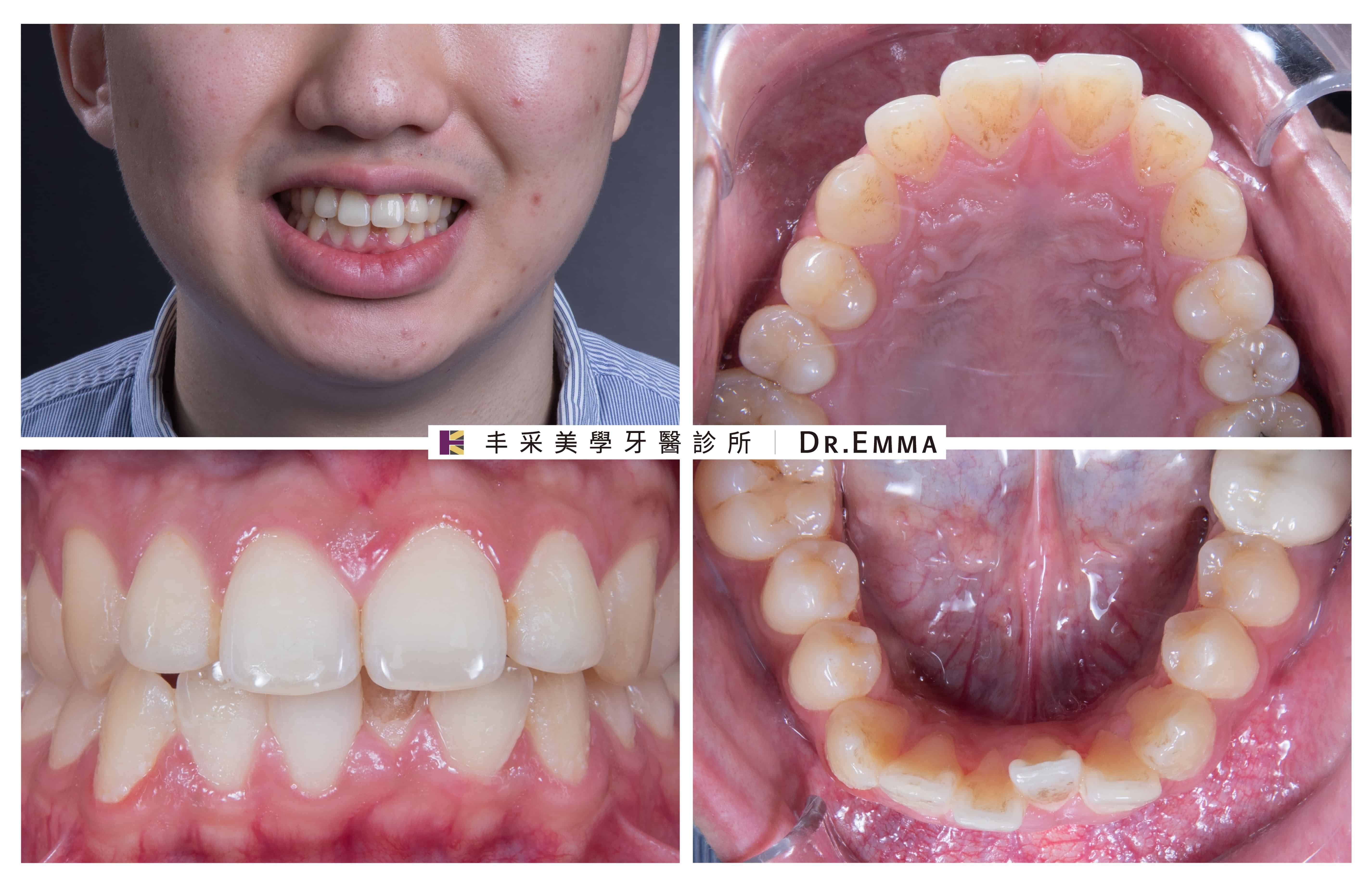 二次牙齒矯正-劉先生案例-1