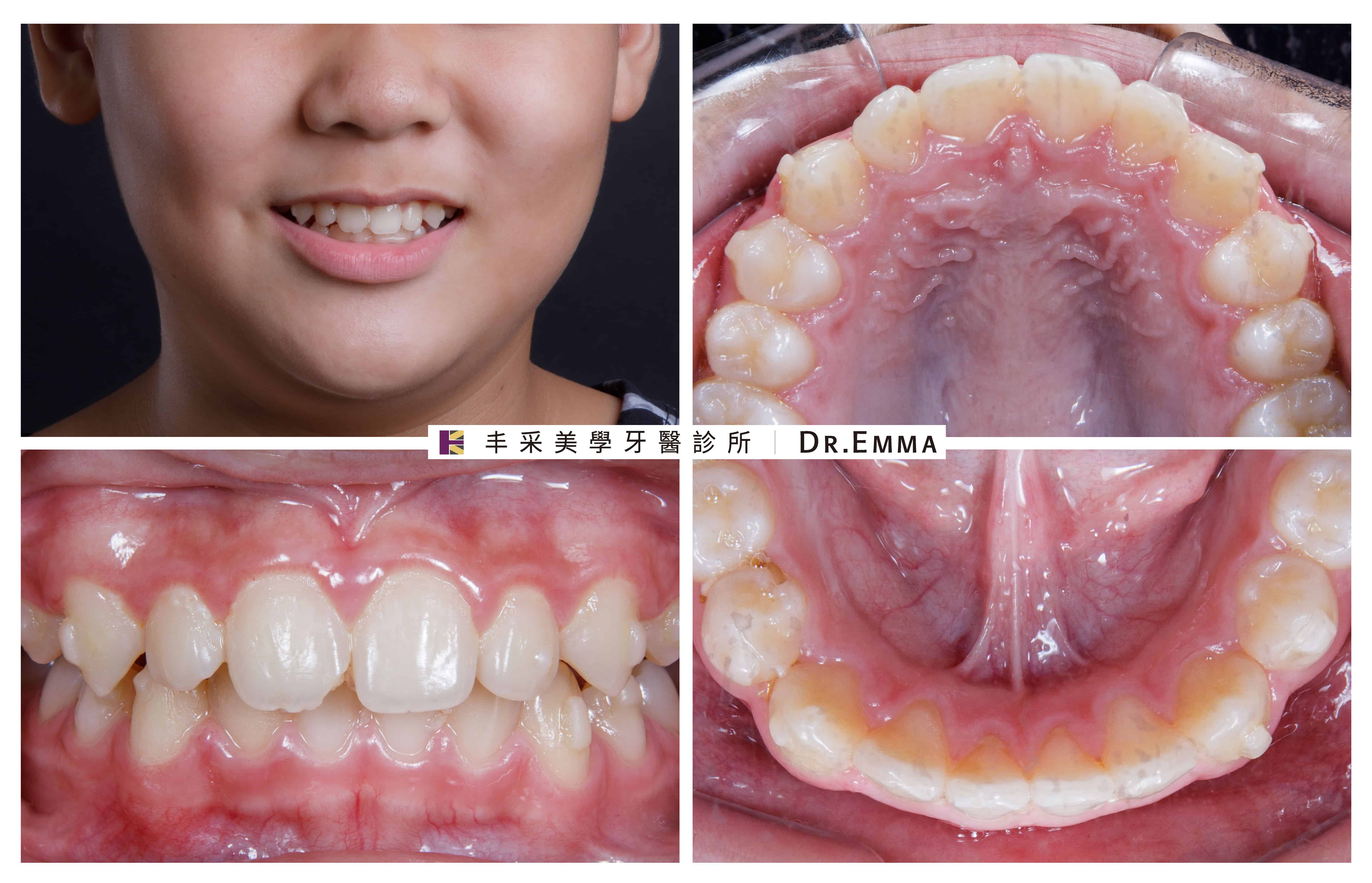 牙齒矯正案例-王同學-2