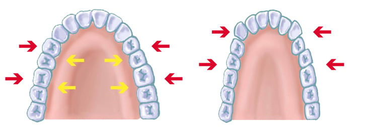 上顎牙弓正常與狹窄差異