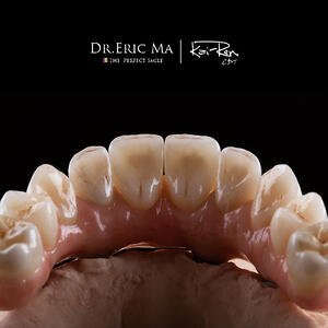 All on 4 高仿真全瓷冠 Dr.Eric Ma 馬永昌醫師