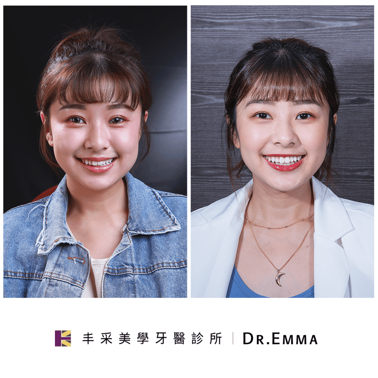 隱適美牙套案例-君君