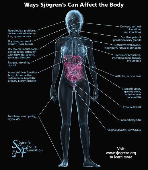 Sjogren's syndrome