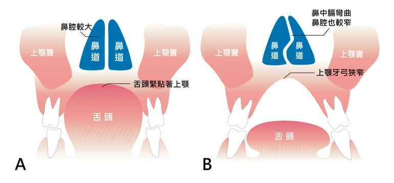 正常呼吸與口呼吸比較圖