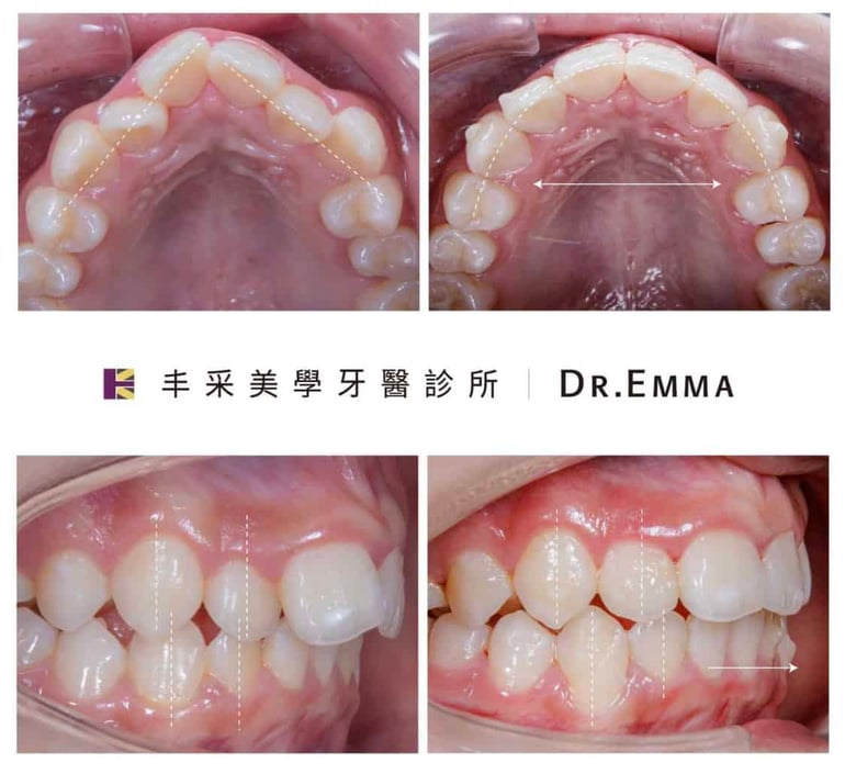 牙齒矯正案例