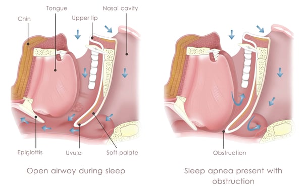 磨牙與睡眠呼吸中止症