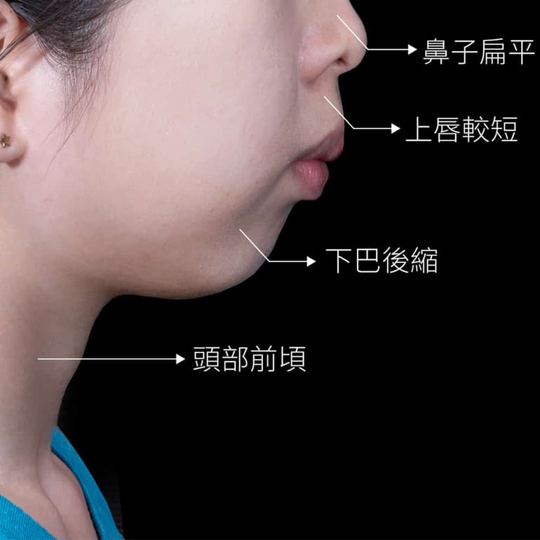 口呼吸長相特徵