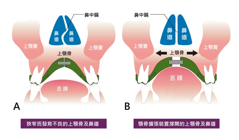 兒童口呼吸矯正方式示意圖