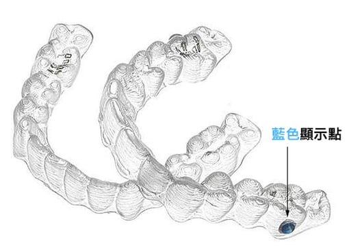 青少年隱適美透明牙套｜Dr.EMMA蔡宜均醫師