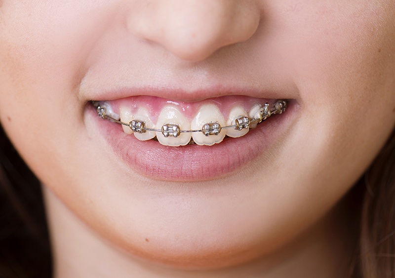 graphicstock-teenage-girl-with-the-braces-on-her-teeth-is-having-a-treatment-at-dentist_BRMP0Kc-Z
