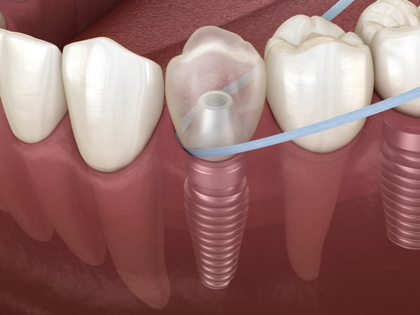 植牙如何用牙線? 丰采美學牙醫