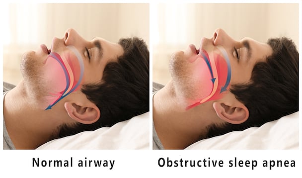 成人睡眠呼吸中止症