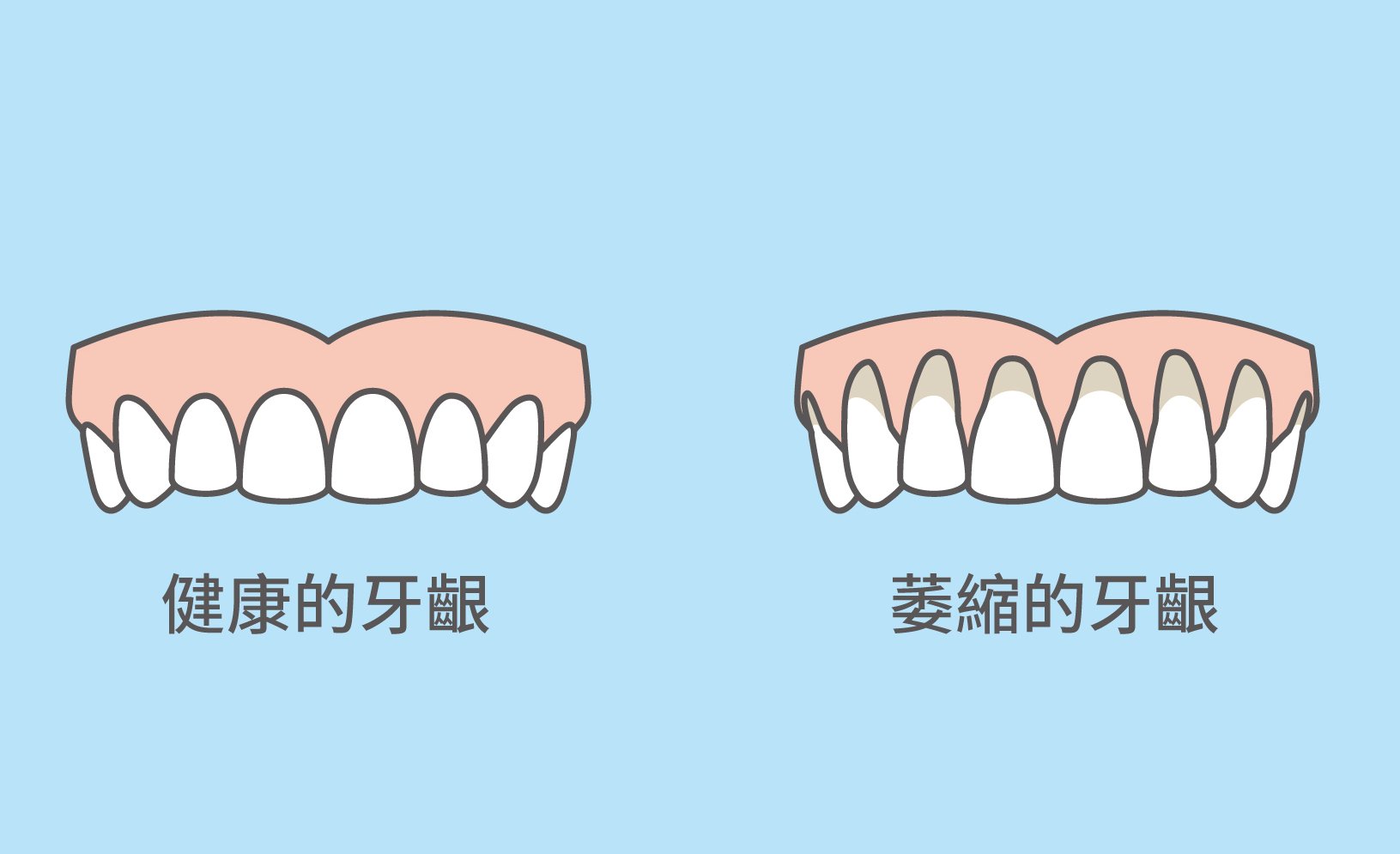 牙齦萎縮