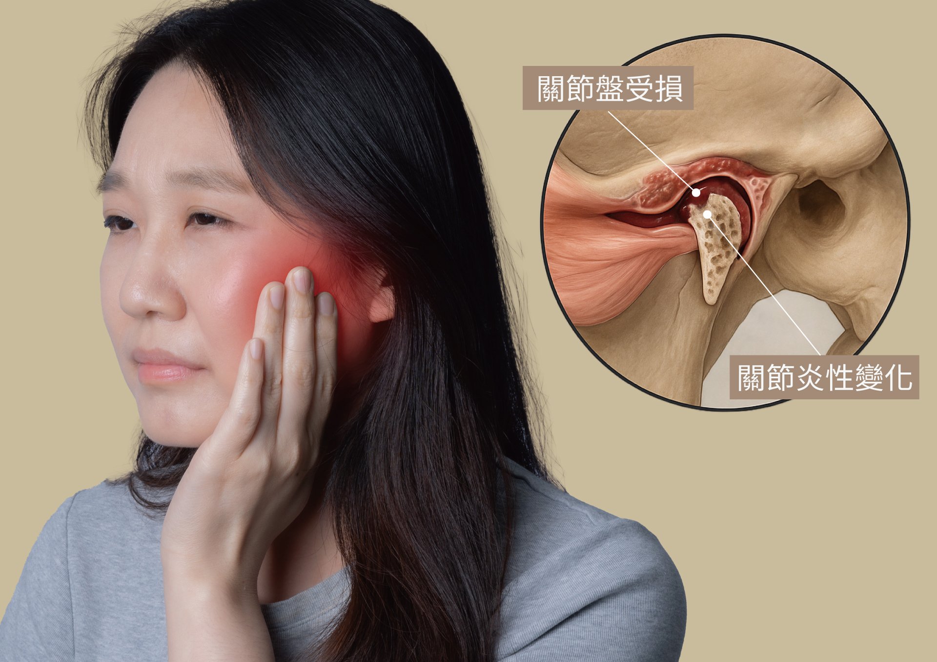 顳顎關節症候群