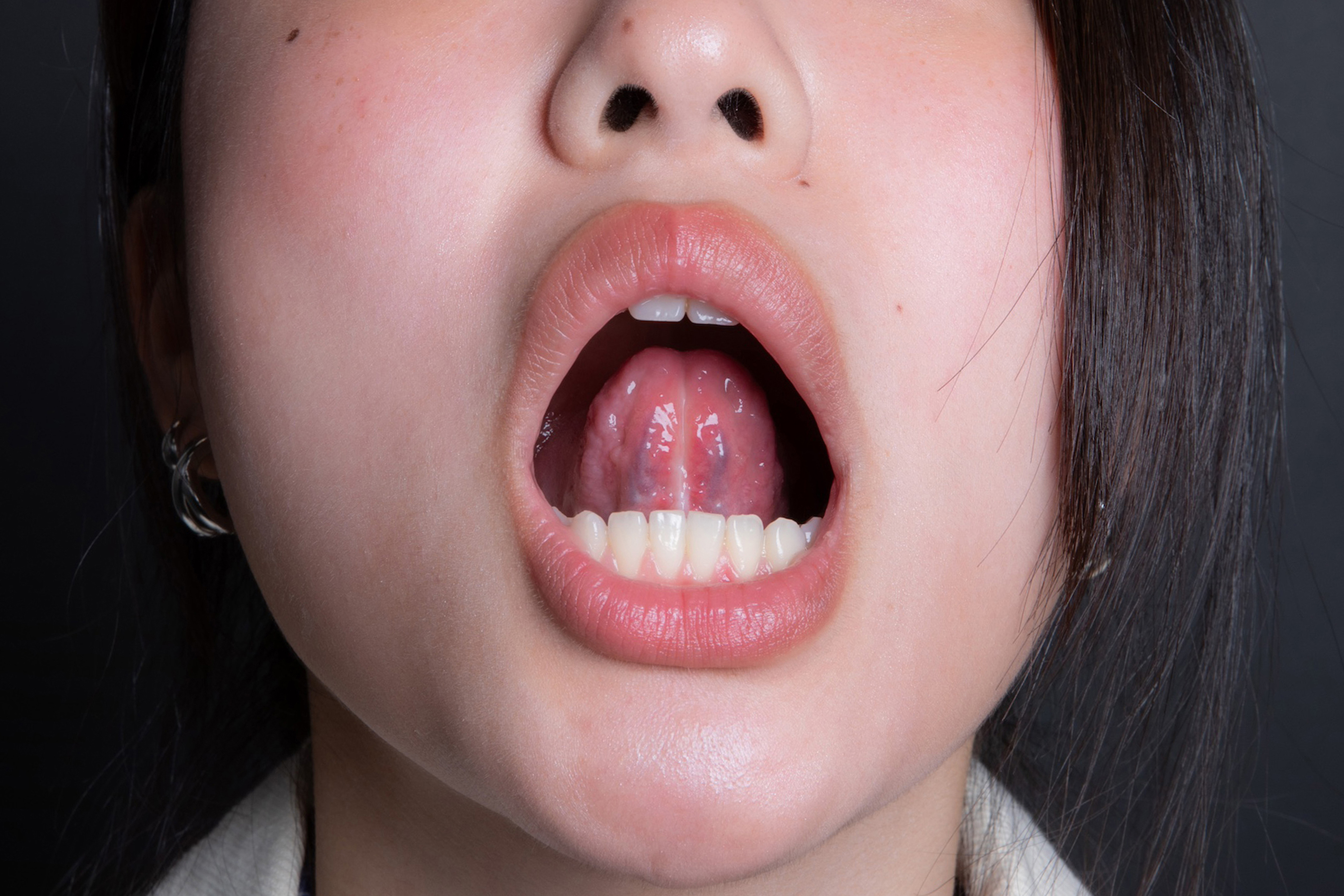 舌繫帶過短after