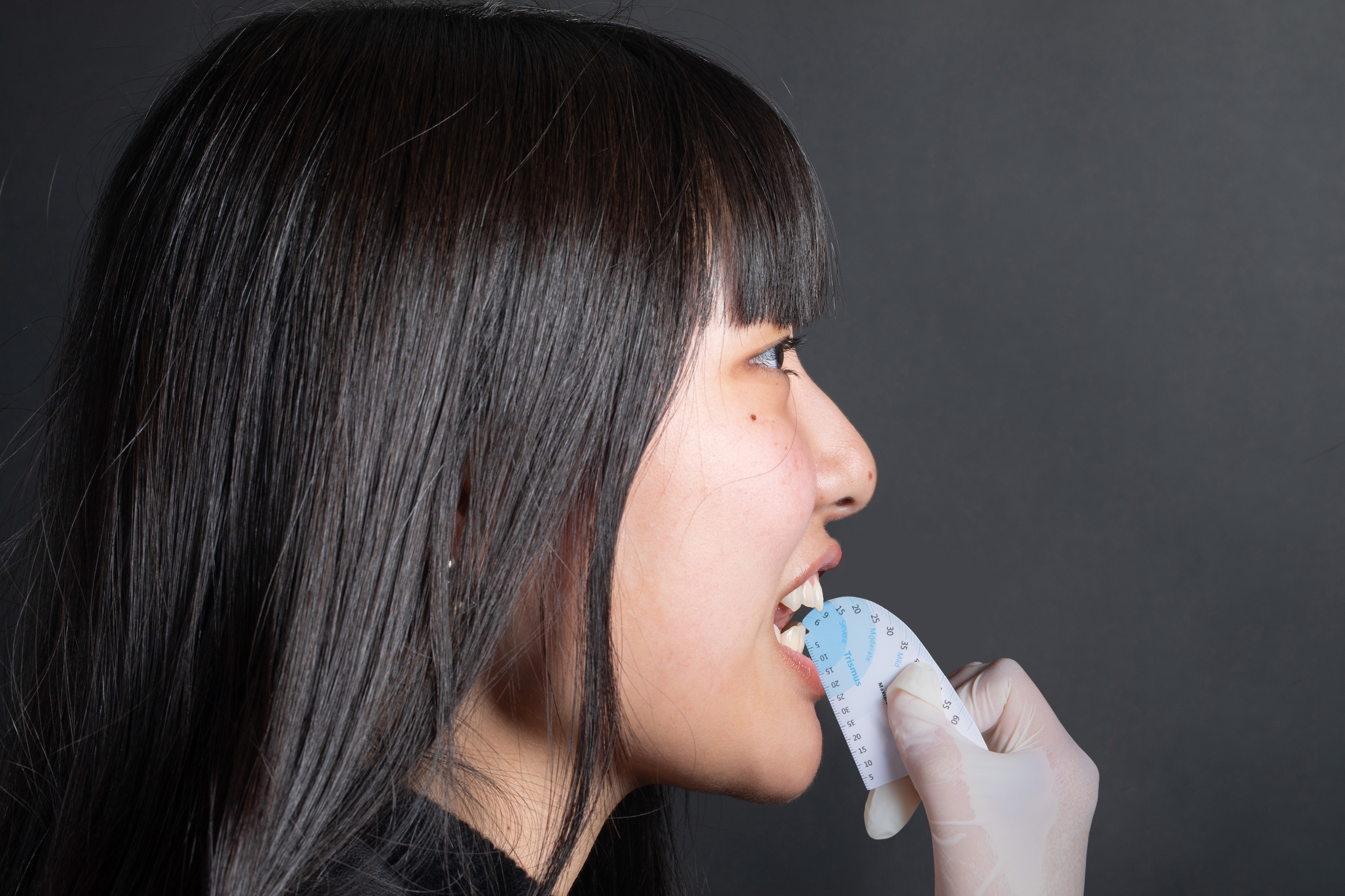 舌繫帶過短案例