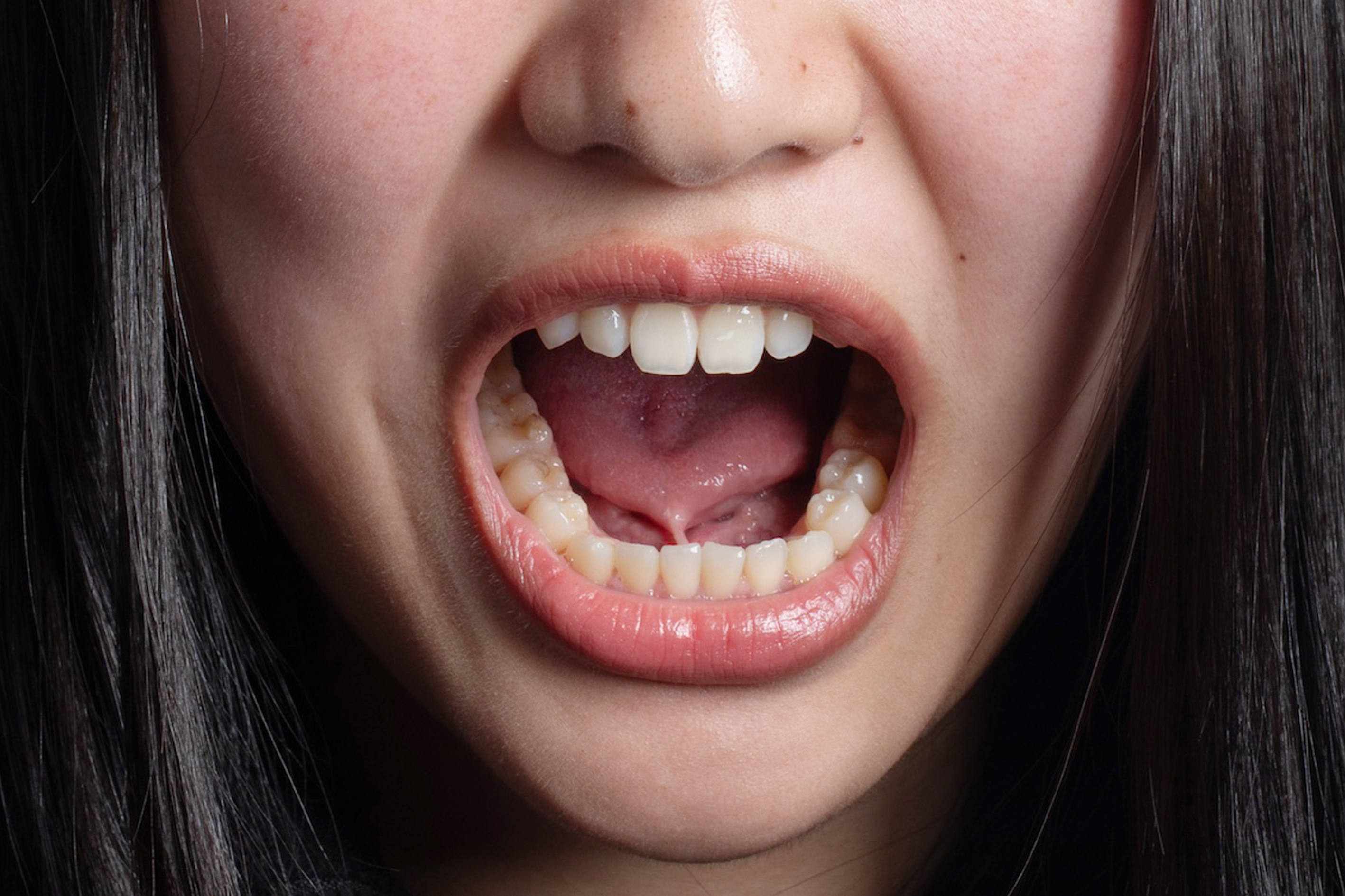 舌繫帶過短before