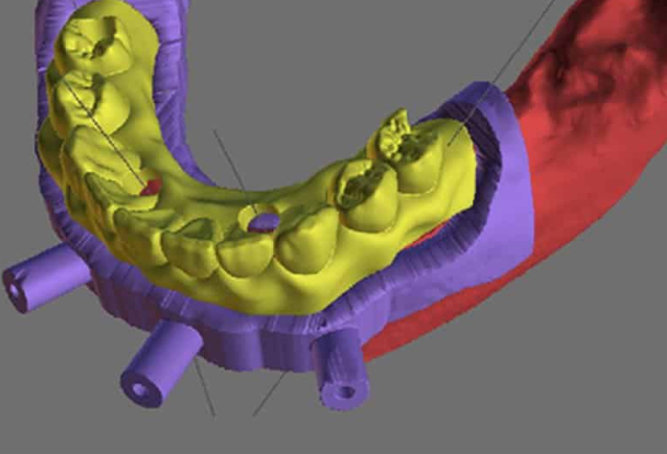 植牙流程｜電腦輔助設計