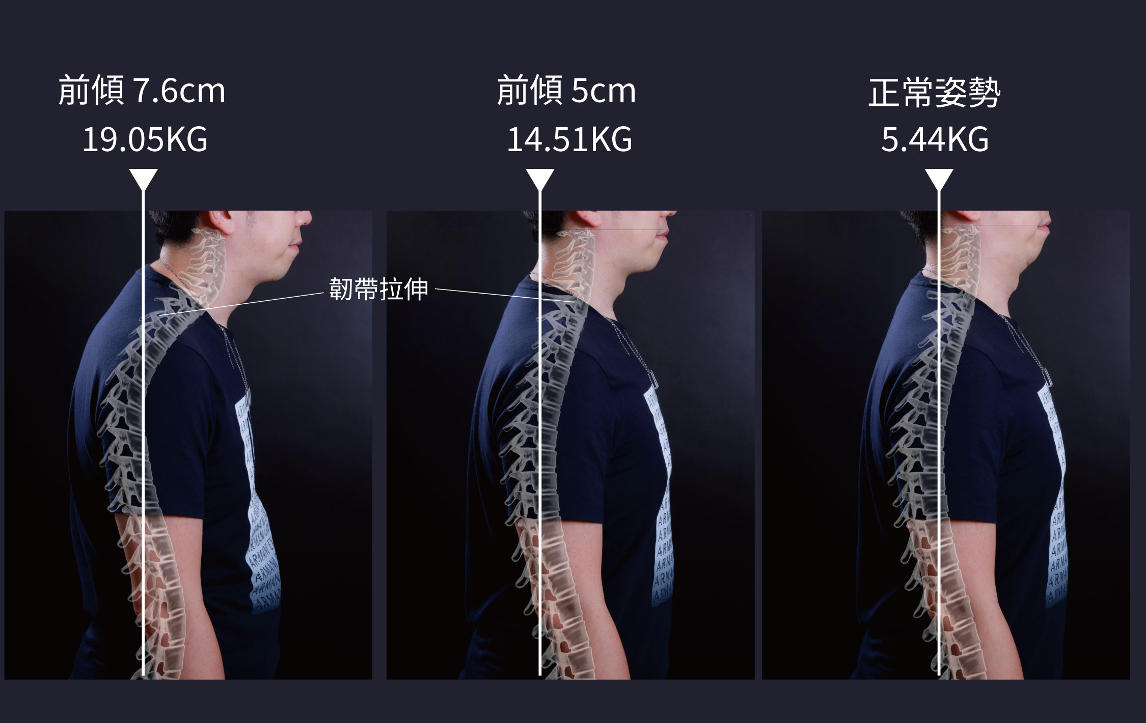 下顎發育不良與脊椎側彎的關聯性_5