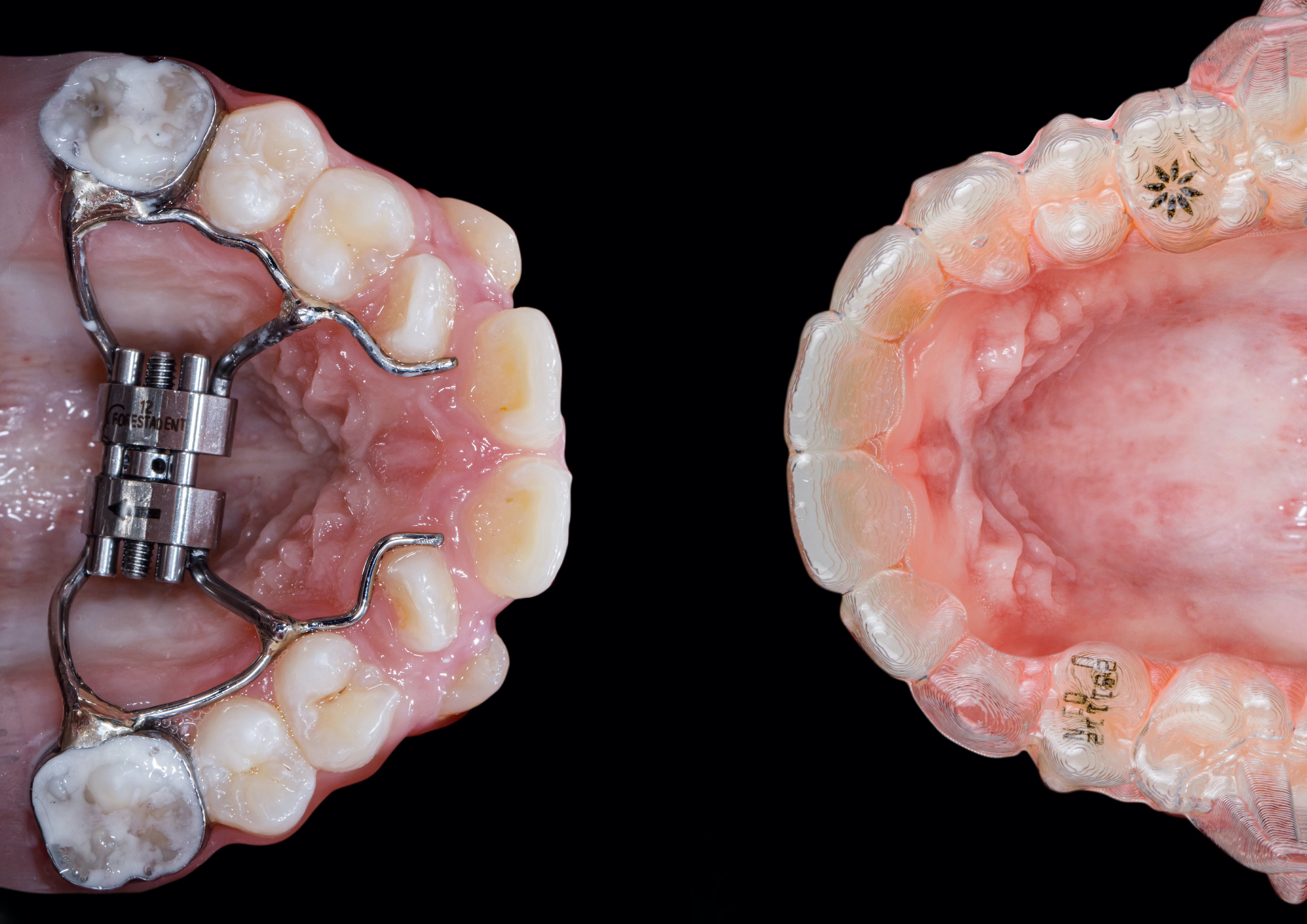 RPE vs Invisalign