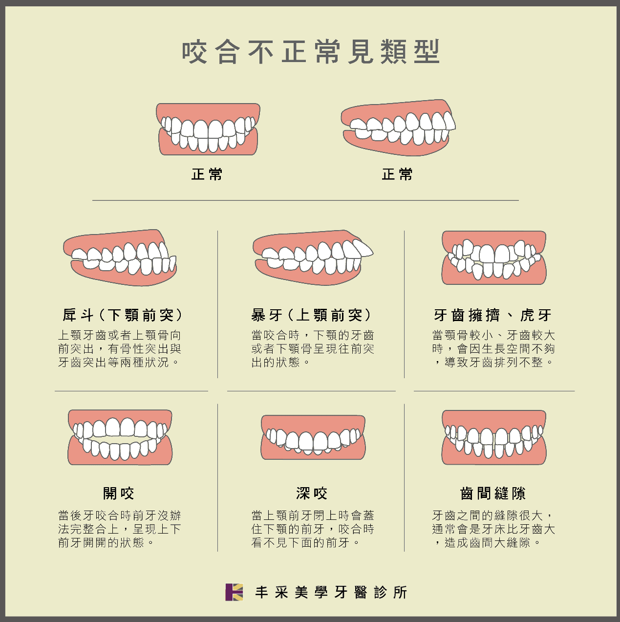 咬合不正類型