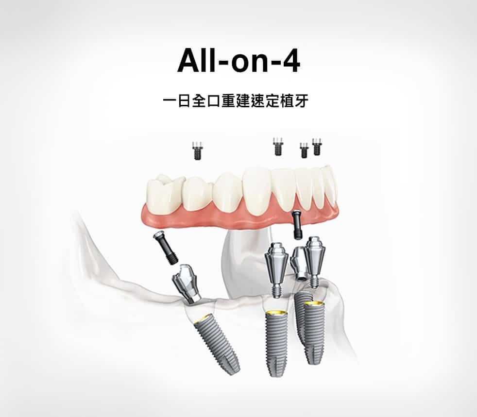 All-on-4全口重建速定植牙