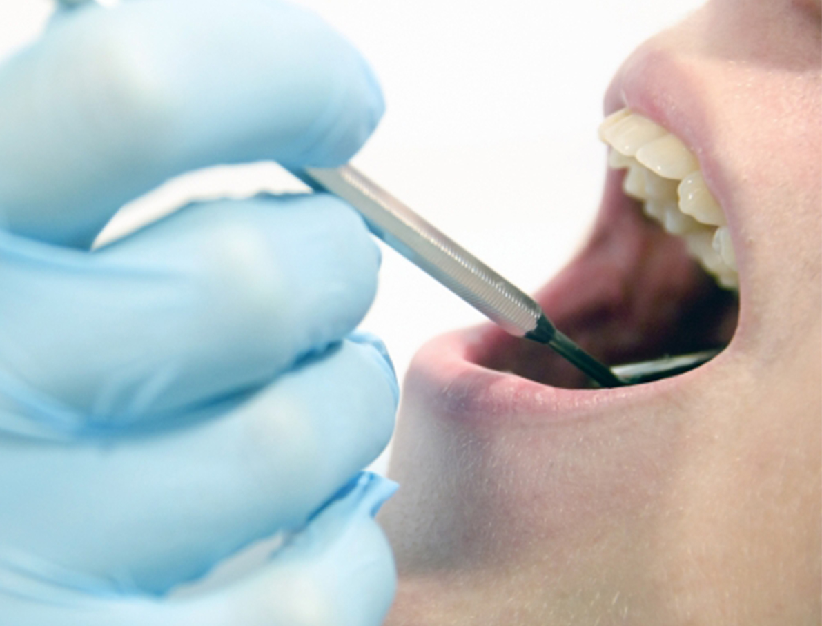 丰采美學牙醫-健保給付洗牙示意圖