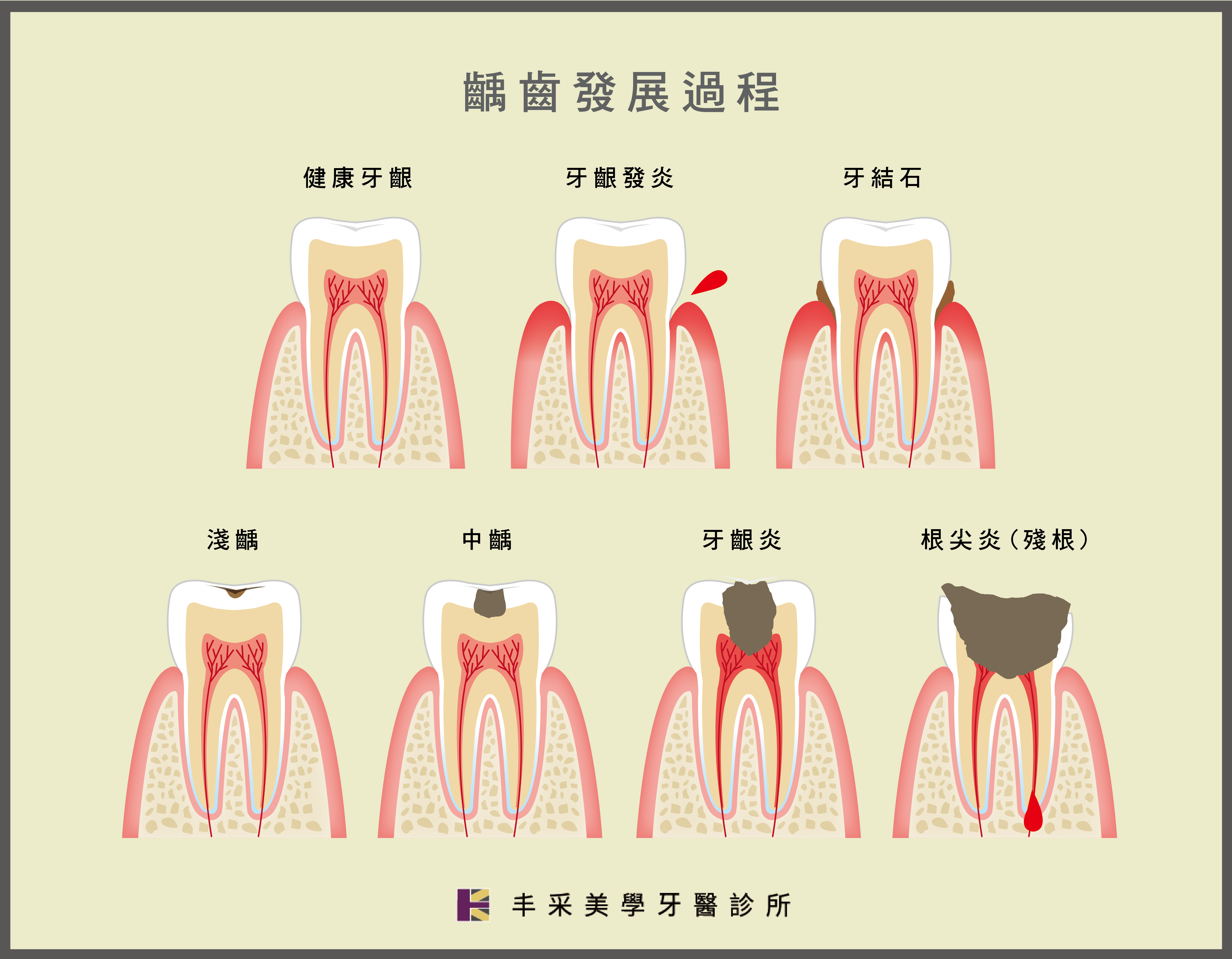 丰采美學牙醫-齲齒(蛀牙)發展過程示意圖