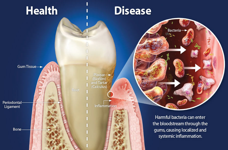 healthy-gum-tissue-vs-diseased-1