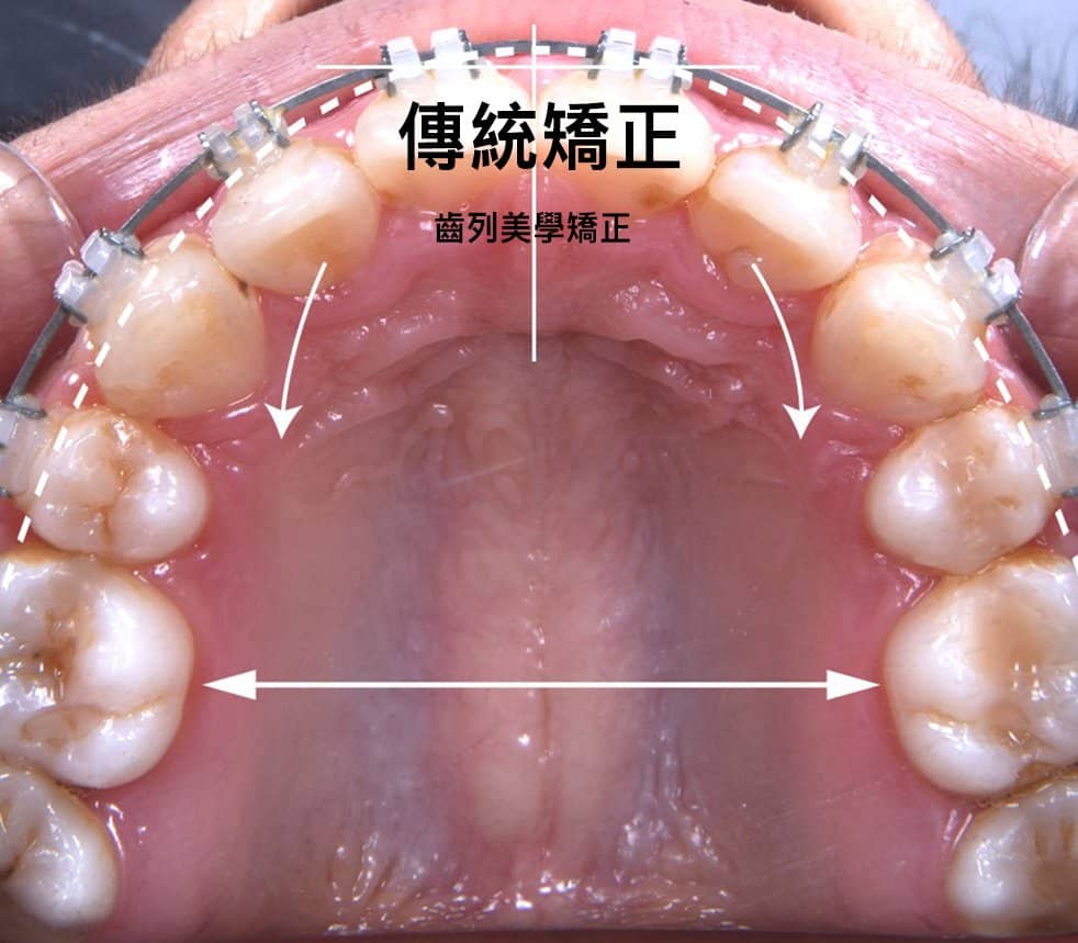 傳統齒顎矯正